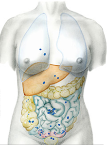 endometriose-schema